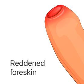 Are Phimosis Rings Effective for Stretching your for Foreskin