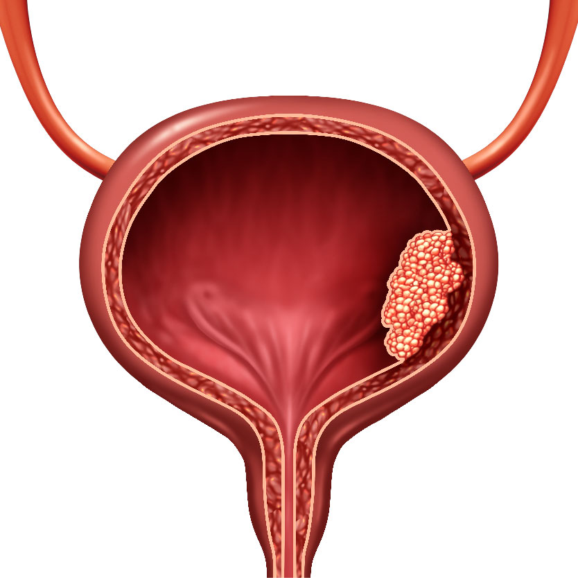 Bladder Cancer Surgery Safe & Affordable Procedure, Near me in Gurgaon