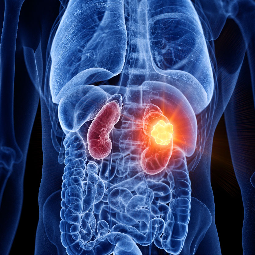 Kidney Cancer Surgery - Safe & Affordable Procedure, Near me in Gurgaon Kidney Cancer Surgery - Safe & Affordable Procedure, Near me in Gurgaon